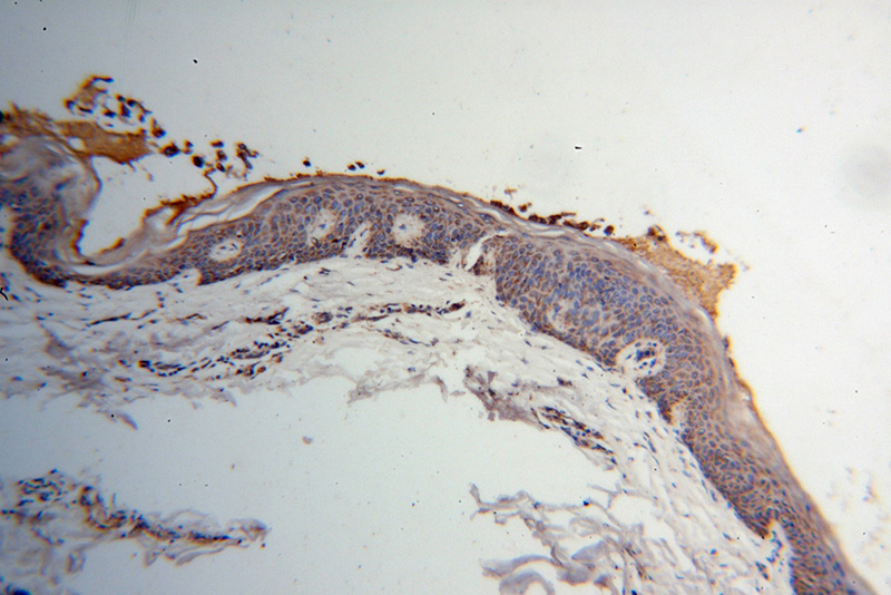 Immunohistochemical of paraffin-embedded human skin cancer using Catalog No:113679(PDHB antibody) at dilution of 1:100 (under 10x lens)