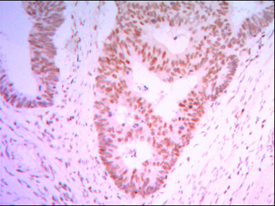 Fig4: Immunohistochemical analysis of paraffin-embedded human ovary cancer tissue using anti-THAP11 antibody. Counter stained with hematoxylin.