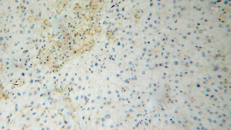 Immunohistochemical of paraffin-embedded human liver cancer using Catalog No:115227(SIGLEC9 antibody) at dilution of 1:100 (under 10x lens)
