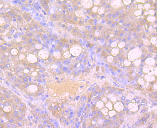 Fig3:; Immunohistochemical analysis of paraffin-embedded human liver carcinoma tissue using anti-Growth Hormone antibody. The section was pre-treated using heat mediated antigen retrieval with Tris-EDTA buffer (pH 9.0) for 20 minutes.The tissues were blocked in 1% BSA for 30 minutes at room temperature, washed with ddH; 2; O and PBS, and then probed with the primary antibody ( 1/50) for 30 minutes at room temperature. The detection was performed using an HRP conjugated compact polymer system. DAB was used as the chromogen. Tissues were counterstained with hematoxylin and mounted with DPX.