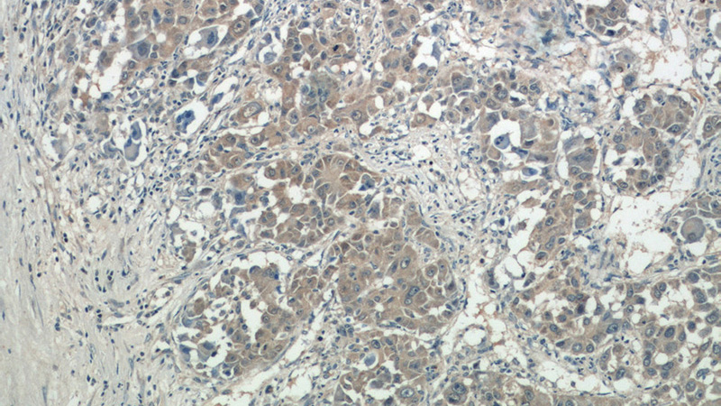 Immunohistochemistry of paraffin-embedded human liver cancer tissue slide using Catalog No:115386(SMCR7,MID49 Antibody) at dilution of 1:50 (under 10x lens)