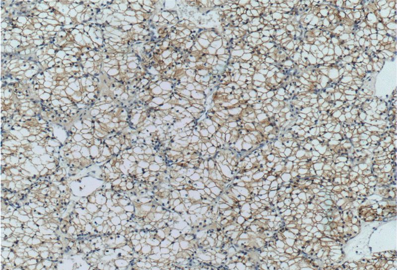 Immunohistochemistry of paraffin-embedded human renal cell carcinoma tissue slide using Catalog No:108740(CA9 Antibody) at dilution of 1:50 (under 10x lens)