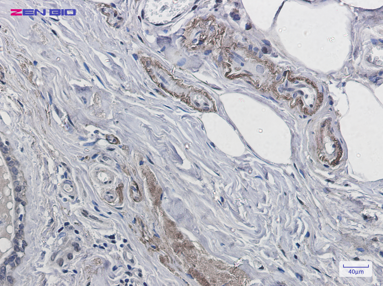 Immunohistochemistry of Prion protein PrP in paraffin-embedded Human breast cancer tissue using Prion protein PrP Rabbit pAb at dilution 1/20