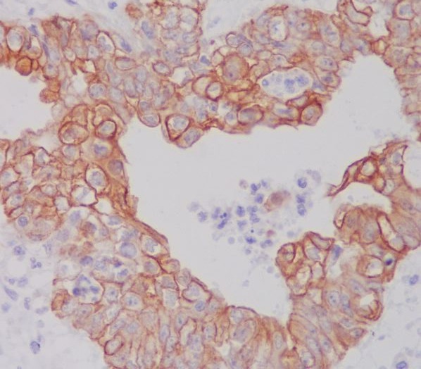 Immunohistochemical analysis of paraffin-embedded human ovarian cancer, using ATG5 Antibody.