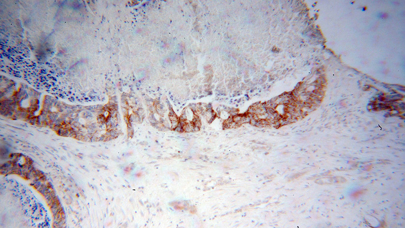 Immunohistochemical of paraffin-embedded human liver cancer using Catalog No:109567(CRLS1-Specific antibody) at dilution of 1:50 (under 10x lens)