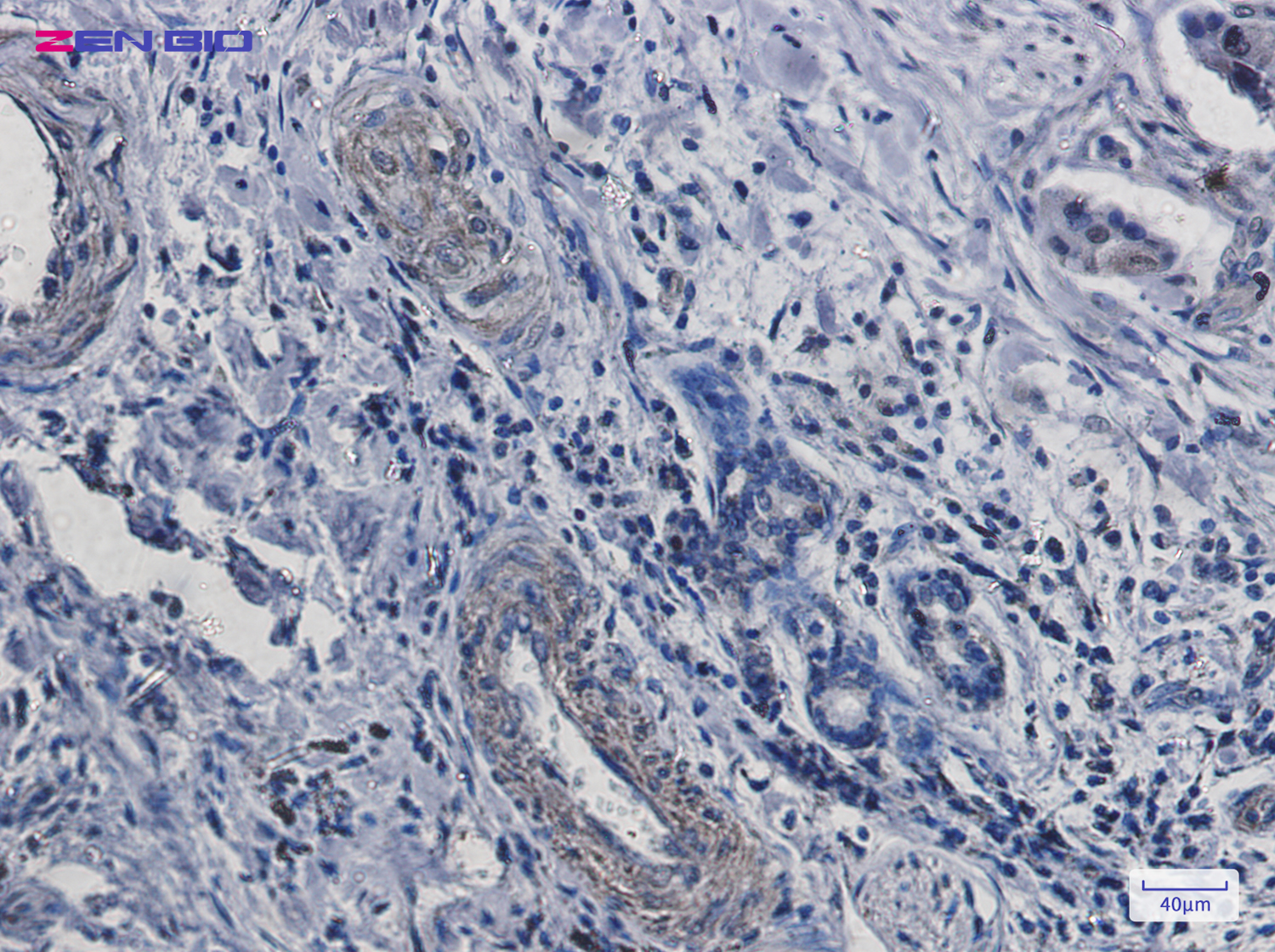 Immunohistochemistry of TTF1 in paraffin-embedded Human lung cancer tissue using TTF1 Rabbit pAb at dilution 1/50