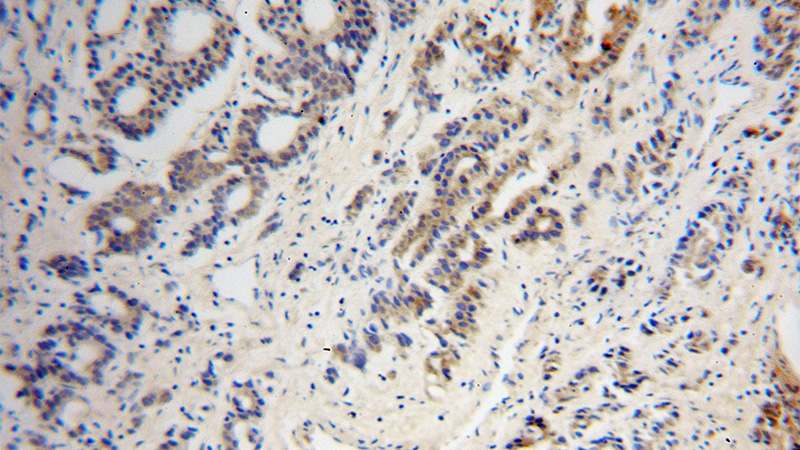 Immunohistochemical of paraffin-embedded human gliomas using Catalog No:114571(RCAN2 antibody) at dilution of 1:100 (under 10x lens)