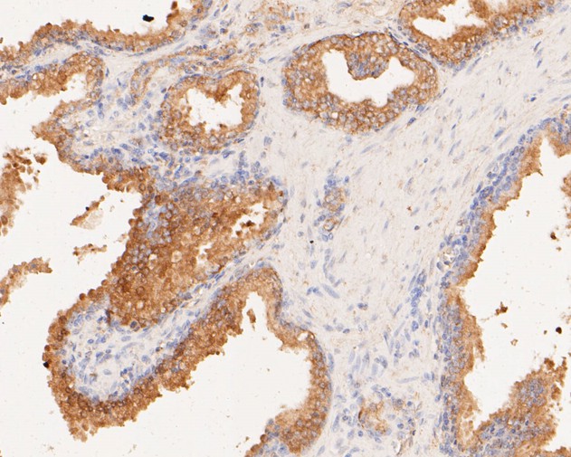 Fig4:; Immunohistochemical analysis of paraffin-embedded human prostate carcinoma tissue using anti-TMEM163 antibody. The section was pre-treated using heat mediated antigen retrieval with Tris-EDTA buffer (pH 8.0-8.4) for 20 minutes.The tissues were blocked in 5% BSA for 30 minutes at room temperature, washed with ddH; 2; O and PBS, and then probed with the primary antibody ( 1/50) for 30 minutes at room temperature. The detection was performed using an HRP conjugated compact polymer system. DAB was used as the chromogen. Tissues were counterstained with hematoxylin and mounted with DPX.