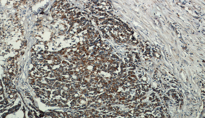 Immunohistochemical of paraffin-embedded human colon cancer using Catalog No:113113(NELL2 antibody) at dilution of 1:50 (under 10x lens)