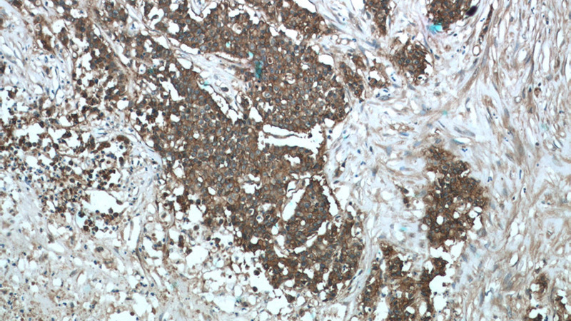 Immunohistochemistry of paraffin-embedded human colon cancer tissue slide using Catalog No:107144(CD9 Antibody) at dilution of 1:50 (under 10x lens)