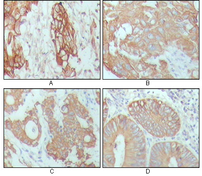 Immunohistochemical analysis of paraffin-embedded human breast carcinoma (A), hepatocarcinoma (B), stomach cancer (C) and colon cancer tissue (D), showing cytoplasmic location with DAB staining using CK18 mouse mAb.