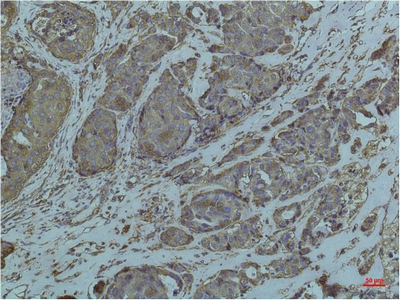 Immunohistochemical analysis of paraffin-embedded Human Breast Caricnoma using GRP78/BipMouse mAb diluted at 1:200.