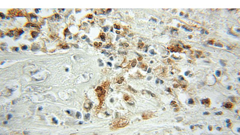 Immunohistochemical of paraffin-embedded human colon cancer using Catalog No:114214(PFN1 antibody) at dilution of 1:50 (under 10x lens)