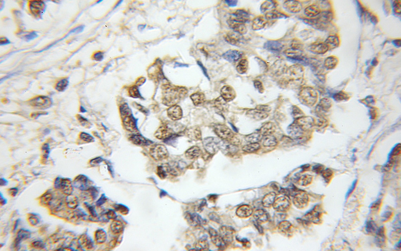Immunohistochemical of paraffin-embedded human breast cancer using Catalog No:111509(HNRNPK antibody) at dilution of 1:50 (under 10x lens)