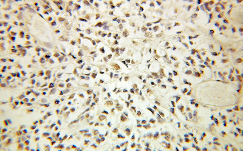 Immunohistochemical of paraffin-embedded human ovary tumor using Catalog No:109668(CCNH antibody) at dilution of 1:100 (under 10x lens)