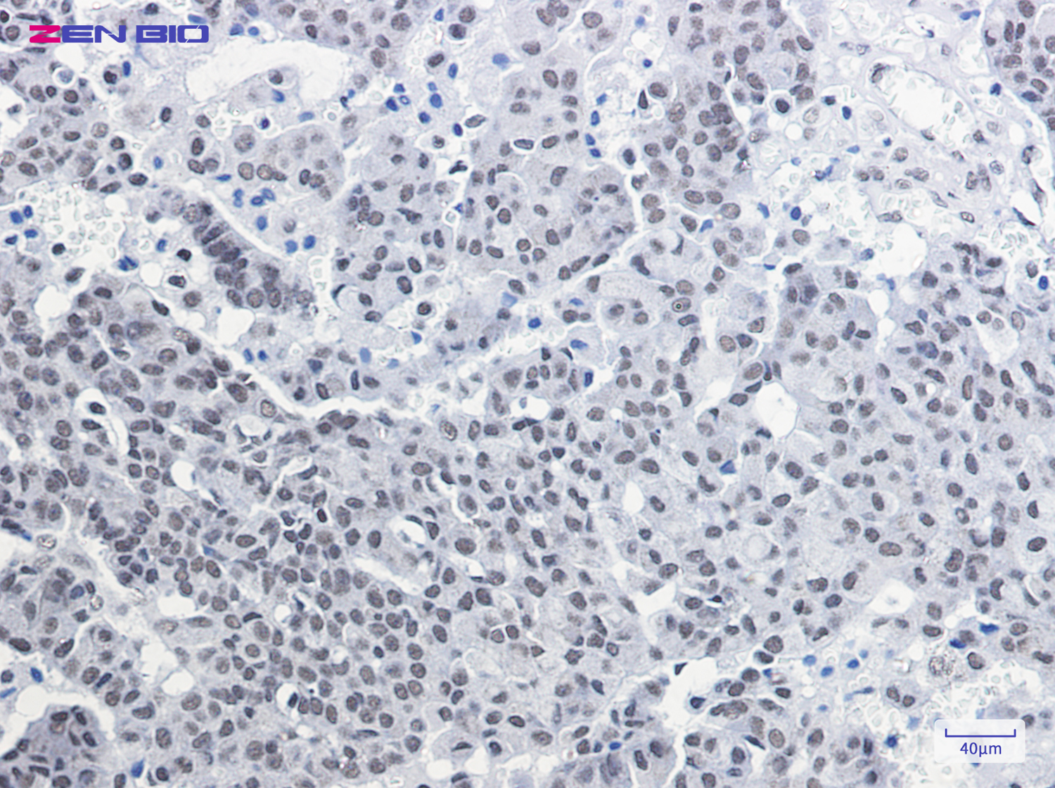 Immunohistochemistry of CGBP in paraffin-embedded Human breast cancer tissue using CGBP Rabbit pAb at dilution 1/50