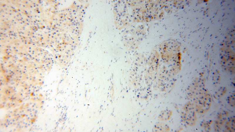 Immunohistochemical of paraffin-embedded human liver cancer using Catalog No:112599(MGLL antibody) at dilution of 1:100 (under 10x lens)