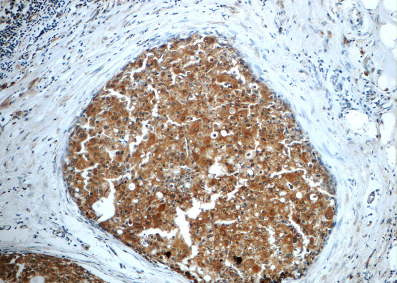 Immunohistochemistry of paraffin-embedded human breast cancer slide using Catalog No:110217(EGFR Antibody) at dilution of 1:50