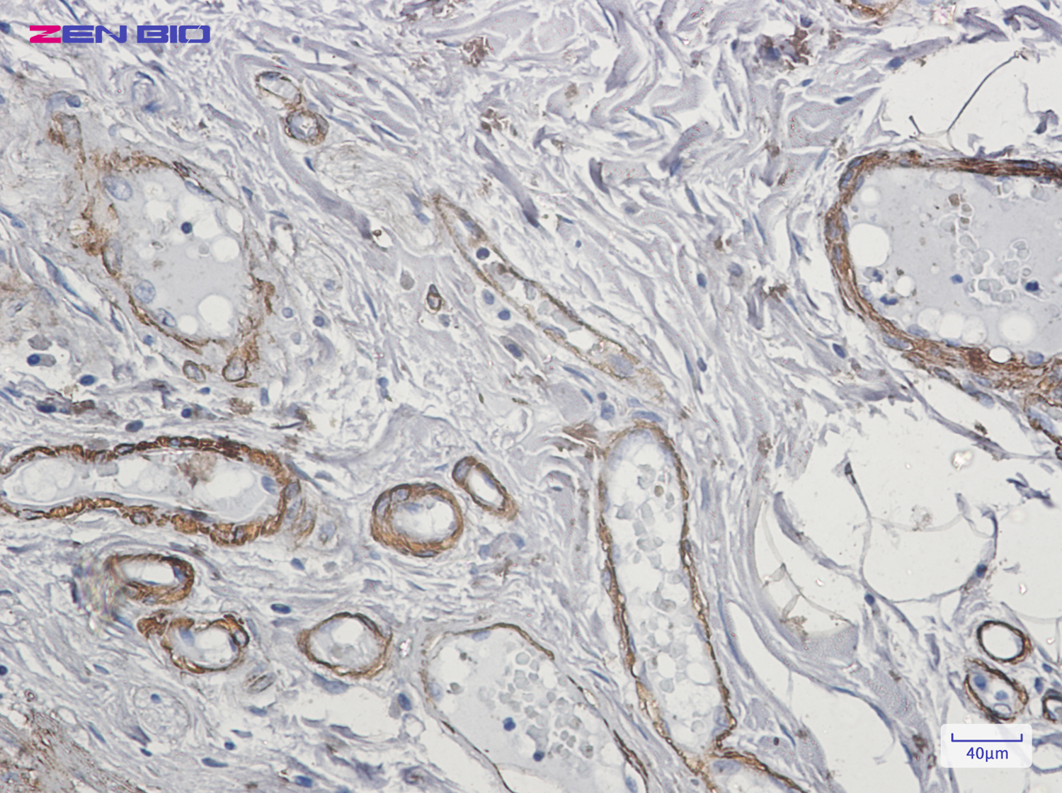Immunohistochemistry of Caldesmon in paraffin-embedded Human colon cancer tissue using Caldesmon Rabbit pAb at dilution 1/20