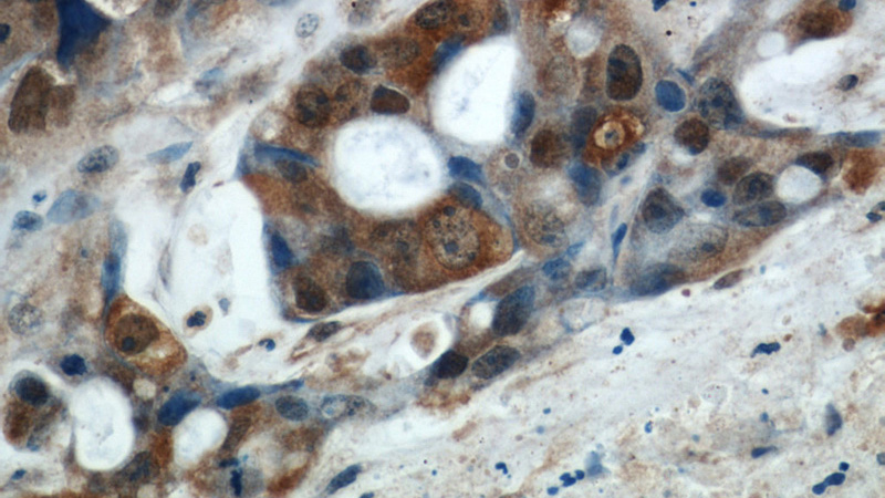 Immunohistochemical of paraffin-embedded human liver cancer using Catalog No:110958(GGCT antibody) at dilution of 1:50 (under 40x lens)
