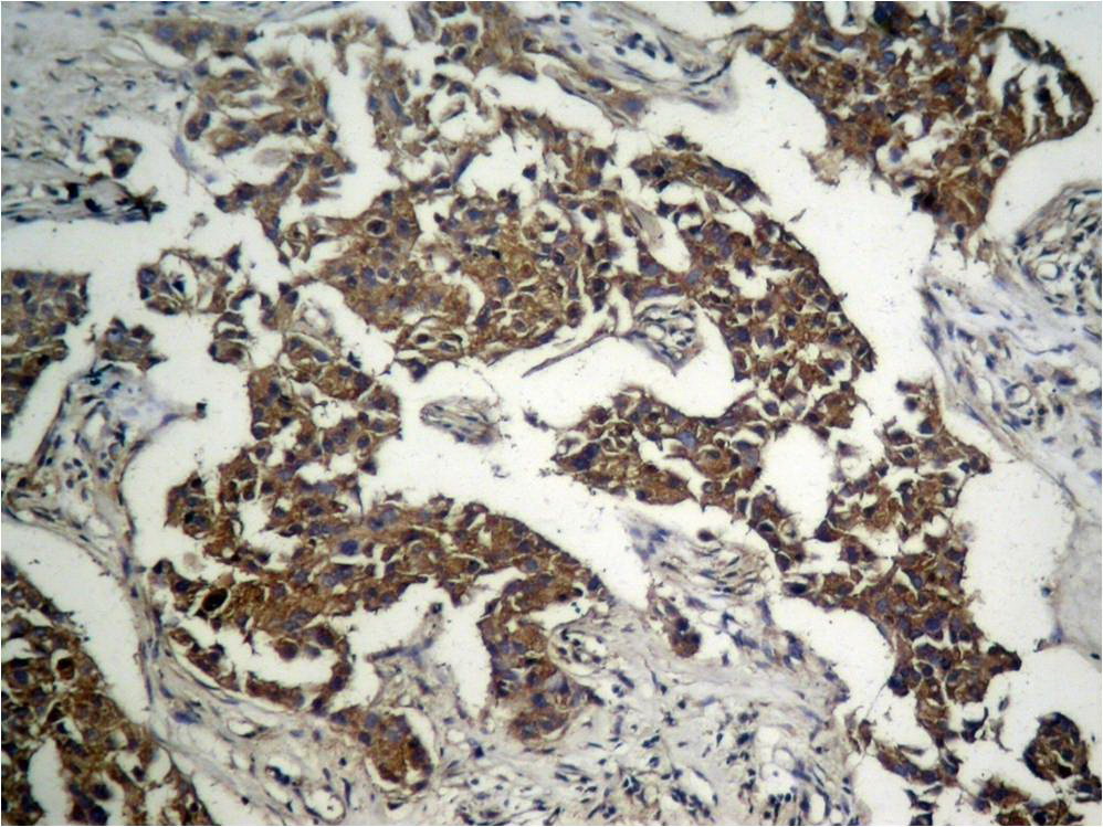 Immunohistochemical analysis of paraffin-embedded human Lung carcinoma tissue using GSK3u03b2 (Phospho-Ser9) Antibody .
