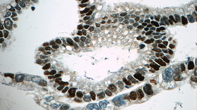 Immunohistochemistry of paraffin-embedded human cervical cancer tissue slide using Catalog No:112556(MCM6 Antibody) at dilution of 1:50 (under 40x lens)