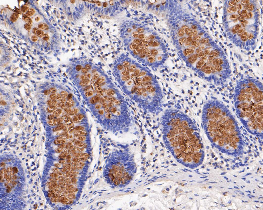 Fig5:; Immunohistochemical analysis of paraffin-embedded human colon tissue using anti-MUC2 antibody. The section was pre-treated using heat mediated antigen retrieval with Tris-EDTA buffer (pH 9.0) for 20 minutes.The tissues were blocked in 5% BSA for 30 minutes at room temperature, washed with ddH; 2; O and PBS, and then probed with the primary antibody ( 1/200) for 30 minutes at room temperature. The detection was performed using an HRP conjugated compact polymer system. DAB was used as the chromogen. Tissues were counterstained with hematoxylin and mounted with DPX.