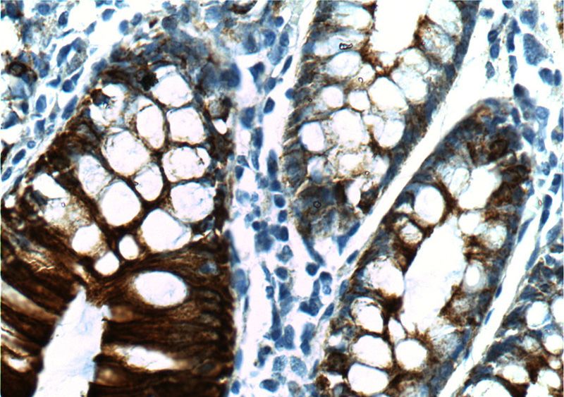 Immunohistochemistry of paraffin-embedded human colon tissue slide using Catalog No:109803(CK19-specific Antibody) at dilution of 1:200 (under 40x lens)