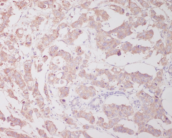Immunohistochemical analysis of paraffin-embedded human breast cancer, using Beclin 1 Antibody.