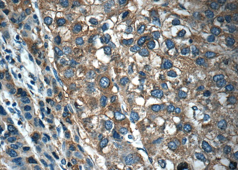 Immunohistochemistry of paraffin-embedded human liver cancer tissue slide using Catalog No:113340(OLFM3 Antibody) at dilution of 1:50 (under 40x lens)