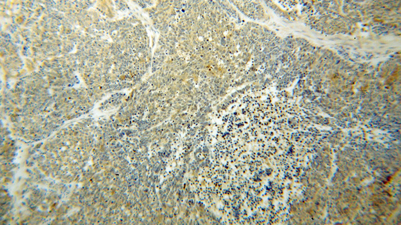 Immunohistochemical of paraffin-embedded human lung cancer using Catalog No:112905(MVD antibody) at dilution of 1:50 (under 10x lens)