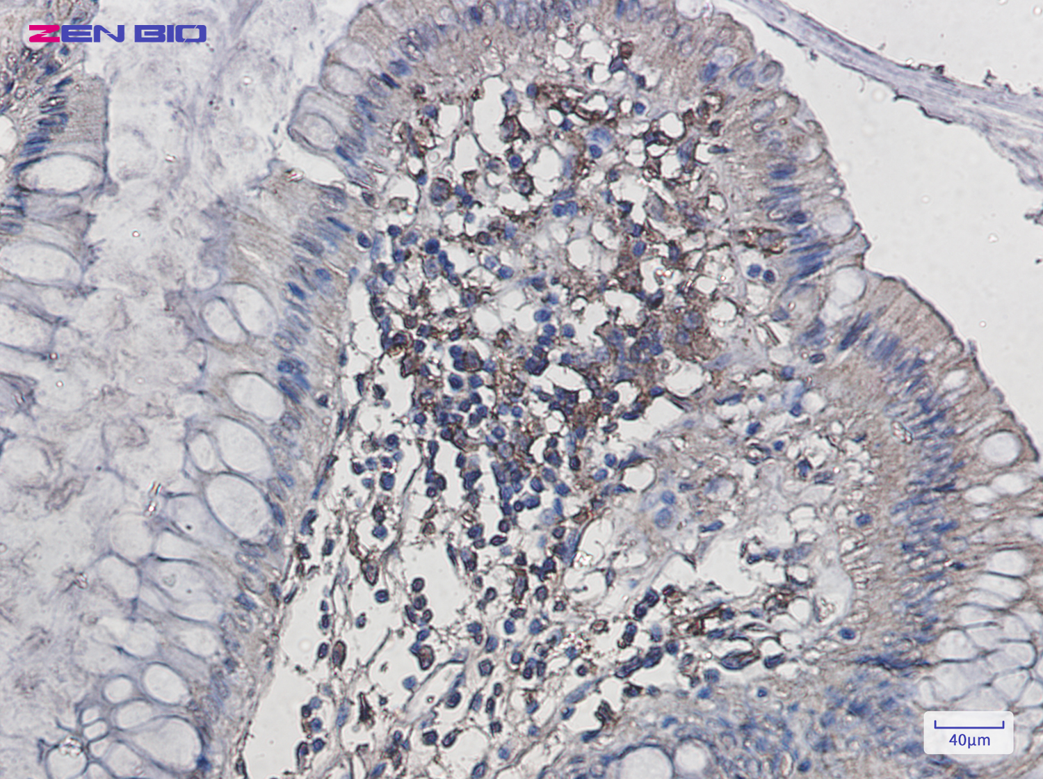 Immunohistochemistry of Iba1 in paraffin-embedded Human colon cancer tissue using Iba1 Rabbit pAb at dilution 1/20