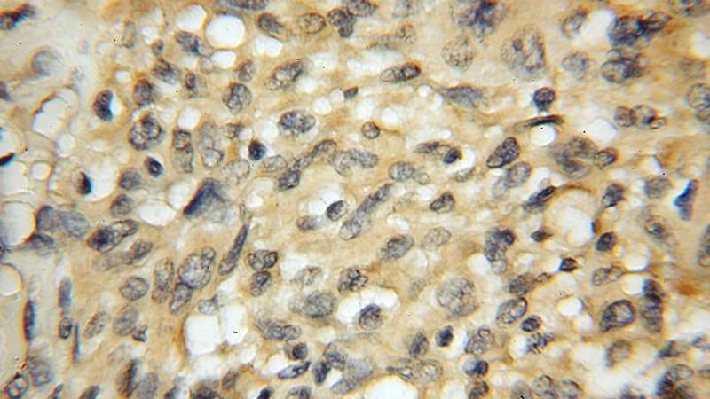 Immunohistochemical of paraffin-embedded human gliomas using Catalog No:116789(VPS45 antibody) at dilution of 1:50 (under 10x lens)