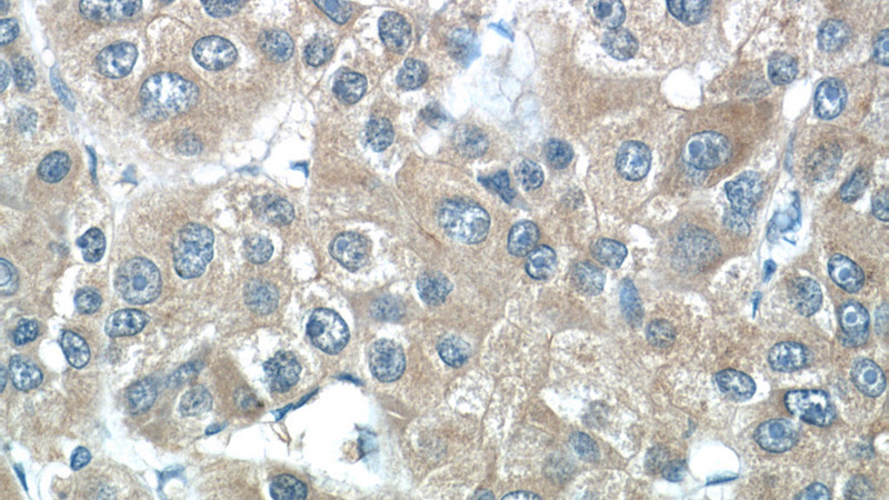 Immunohistochemistry of paraffin-embedded human liver cancer tissue slide using Catalog No:112323(LRP5 Antibody) at dilution of 1:50 (under 40x lens)