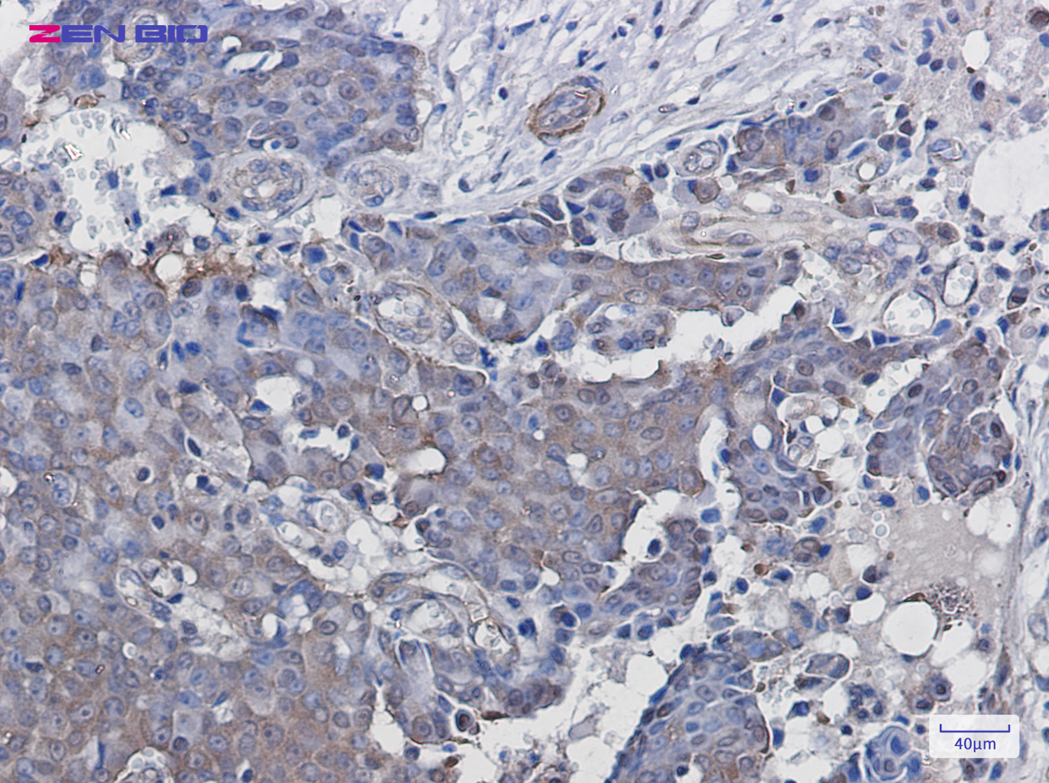 Immunohistochemistry of ADRM1 in paraffin-embedded Human breast cancer tissue using ADRM1 Rabbit pAb at dilution 1/100