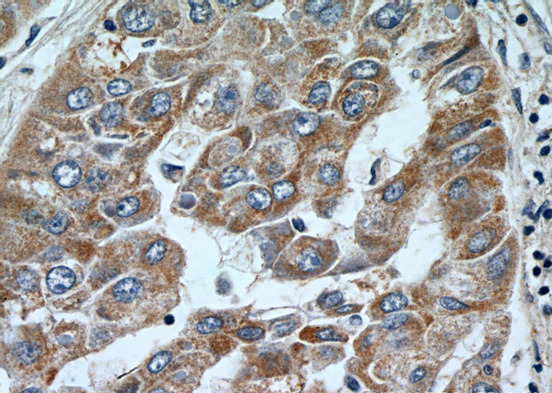 Immunohistochemistry of paraffin-embedded human liver cancer tissue slide using Catalog No:110060(DBH Antibody) at dilution of 1:100 (under 40x lens).