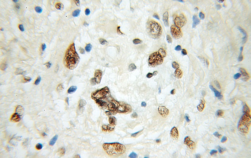 Immunohistochemical of paraffin-embedded human gliomas using Catalog No:113406(NUCKS1 antibody) at dilution of 1:50 (under 40x lens)