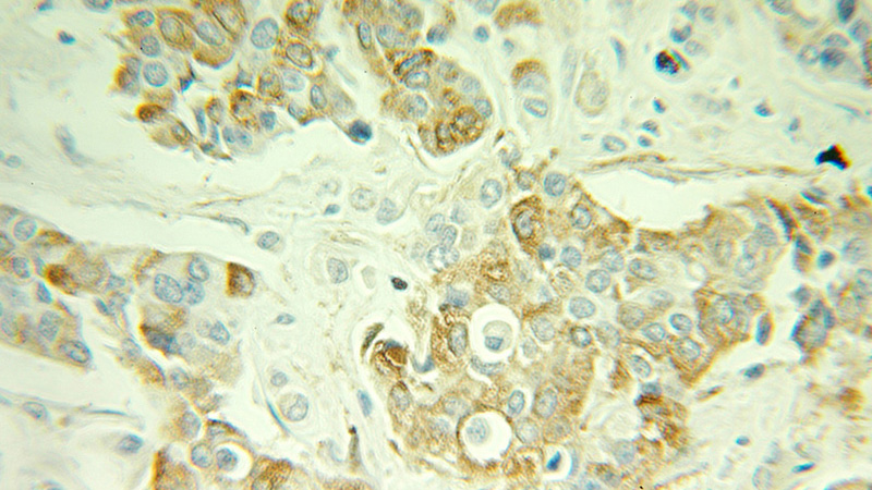 Immunohistochemical of paraffin-embedded human breast cancer using Catalog No:108164(ARPC1B antibody) at dilution of 1:100 (under 25x lens)