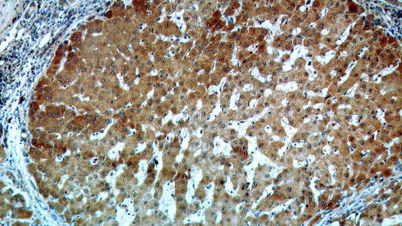 Immunohistochemical of paraffin-embedded human hepatocirrhosis using Catalog No:116362(TSPAN33 antibody) at dilution of 1:50 (under 10x lens)