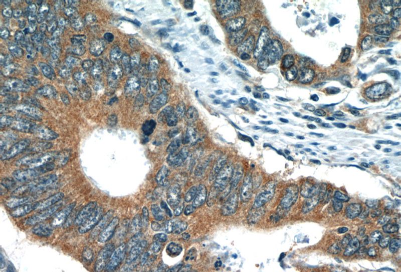 Immunohistochemistry of paraffin-embedded human colon cancer slide using Catalog No:116202(TMF1 Antibody) at dilution of 1:50
