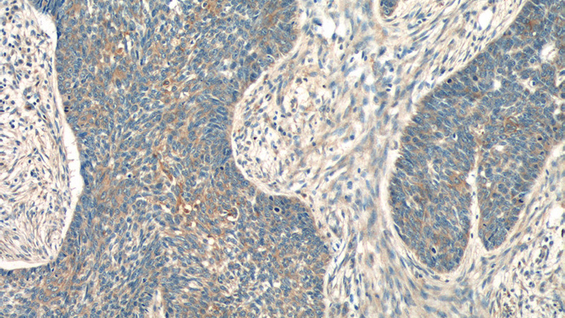 Immunohistochemistry of paraffin-embedded human skin cancer tissue slide using Catalog No:111768(IL19 Antibody) at dilution of 1:50 (under 10x lens)