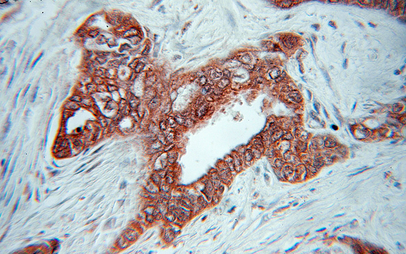 Immunohistochemical of paraffin-embedded human pancreas cancer using Catalog No:110857(JUP antibody) at dilution of 1:50 (under 10x lens)