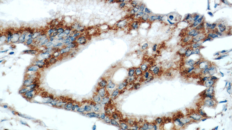Immunohistochemical of paraffin-embedded human pancreas cancer using Catalog No:111221(GRP78,BIP antibody) at dilution of 1:50 (under 40x lens)