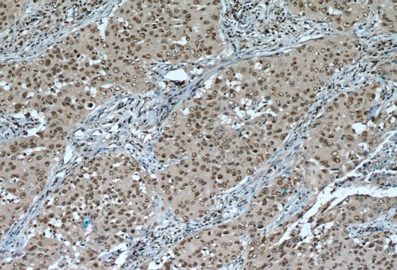 Immunohistochemistry of paraffin-embedded human lung cancer slide using Catalog No:116070(TLE3 Antibody) at dilution of 1:50