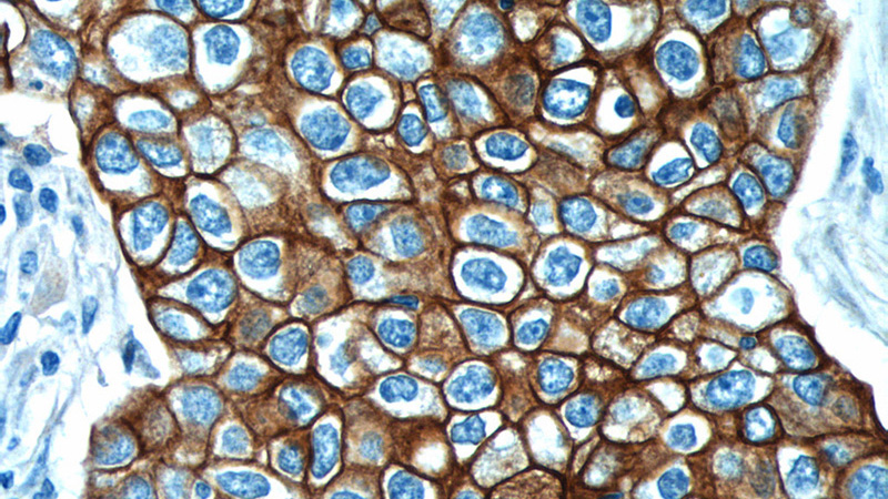 Immunohistochemistry of paraffin-embedded human breast cancer tissue slide using Catalog No:109800(KRT18 Antibody) at dilution of 1:1000 (under 40x lens).