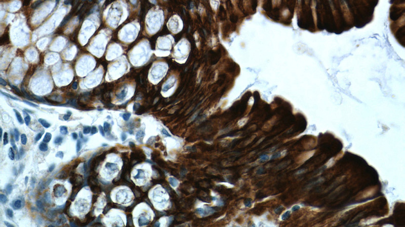 Immunohistochemistry of paraffin-embedded human colon tissue slide using Catalog No:109802(CK19 Antibody) at dilution of 1:200 (under 40x lens)