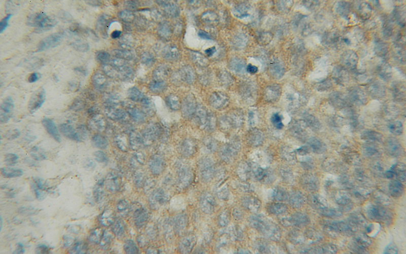 Immunohistochemical of paraffin-embedded human prostate cancer using Catalog No:113891(PIGB antibody) at dilution of 1:50 (under 10x lens)