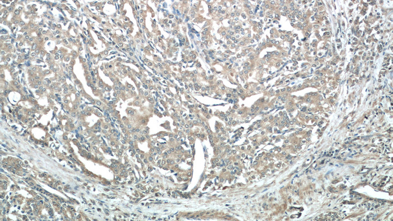 Immunohistochemistry of paraffin-embedded human prostate cancer tissue slide using (KLK3,PSA Antibody) at dilution of 1:50 (under 10x lens)