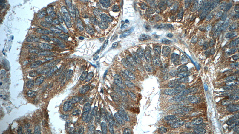 Immunohistochemistry of paraffin-embedded human ovary tumor tissue slide using Catalog No:116189(TMEM5 Antibody) at dilution of 1:50 (under 40x lens)