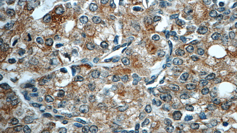 Immunohistochemistry of paraffin-embedded human prostate cancer tissue slide using Catalog No:114180(PREB Antibody) at dilution of 1:50 (under 40x lens)